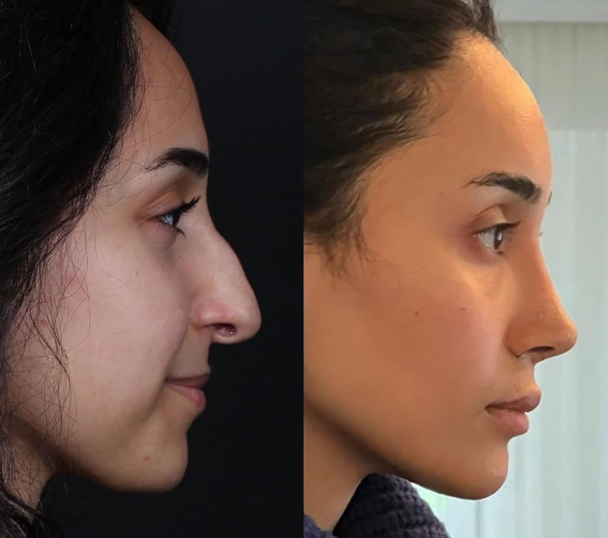 nose job